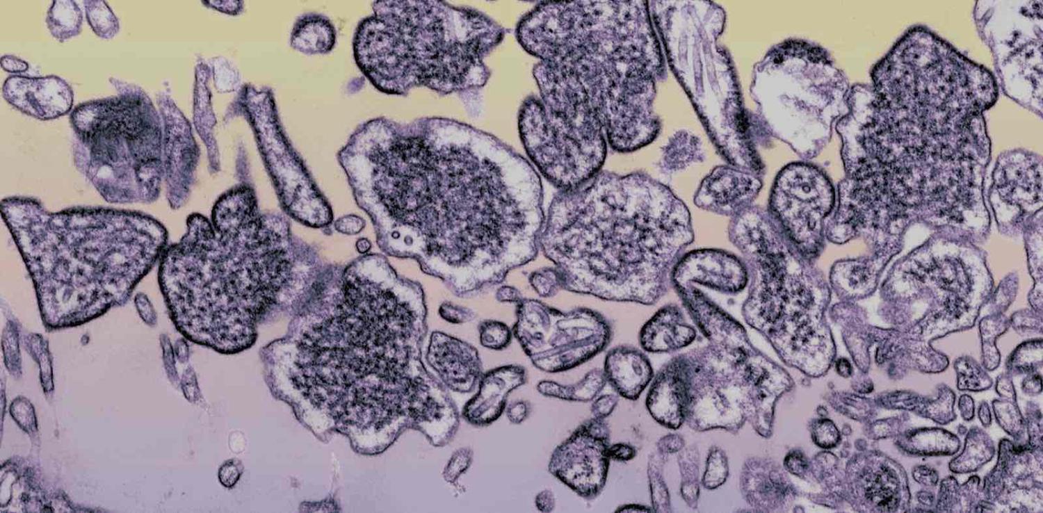 Cerebrospinal fluid of a patient infected with Nipah virus (Photo: BSIP via Getty)
